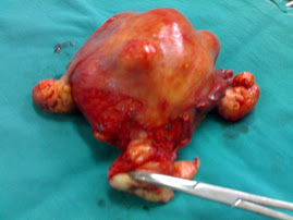 Uterine sarcoma on top of fibroid
