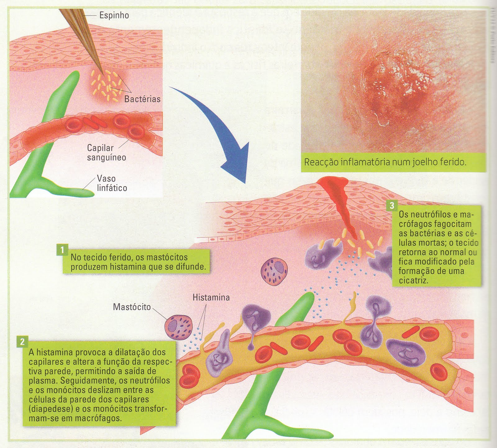 Inflamação Aguda Da Pele - RETOEDU