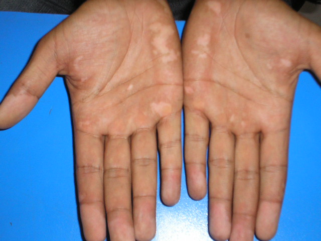 Itchy Palms: Common Causes and Treatments of Itchy Palms