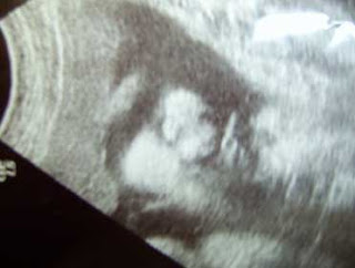 ecografia quinto mes de embarazo