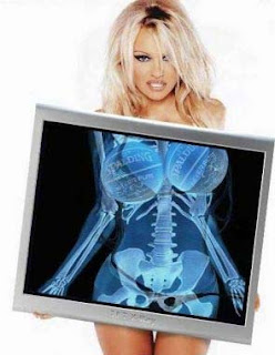 Pamela Anderson's Xray