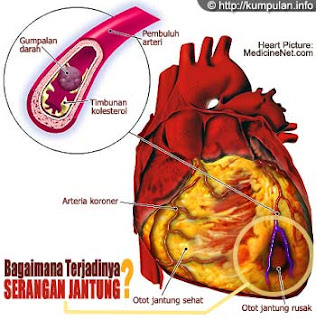 Apa Yang Menyebabkan Serangan Jantung - apa yang menyebabkan sakit jantung koroner 1