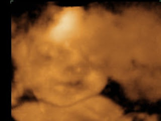 Lone Sunflower: Successful 29 Week 3D Ultrasound