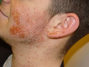 infección estafilocócica de la piel infección estafilocócica de la piel