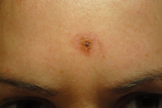 mold skin lesions fungal story after
