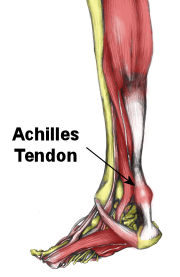IMAGE Graphic of an inflamed Achilles tendon. IMAGE