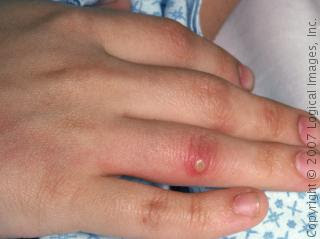 whats the bestway to treat a boil on finger? | Yahoo Answers