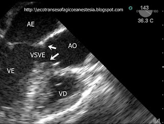 Eco Transesofagico e Anestesiologia: Insuficiência aórtica e estenose ...