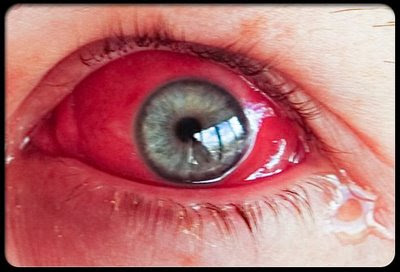 eye pink conjunctivitis infection quia np sensory activities ii