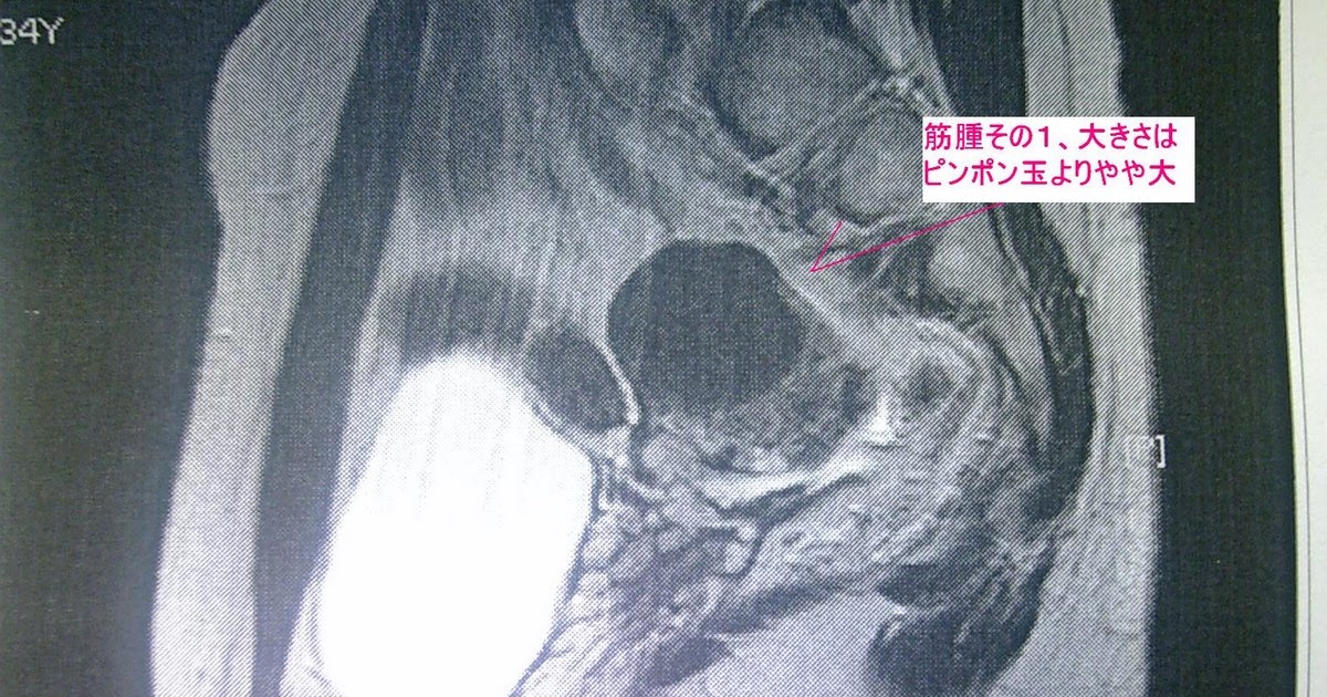 子宮筋腫を治したい！ MRI画像！