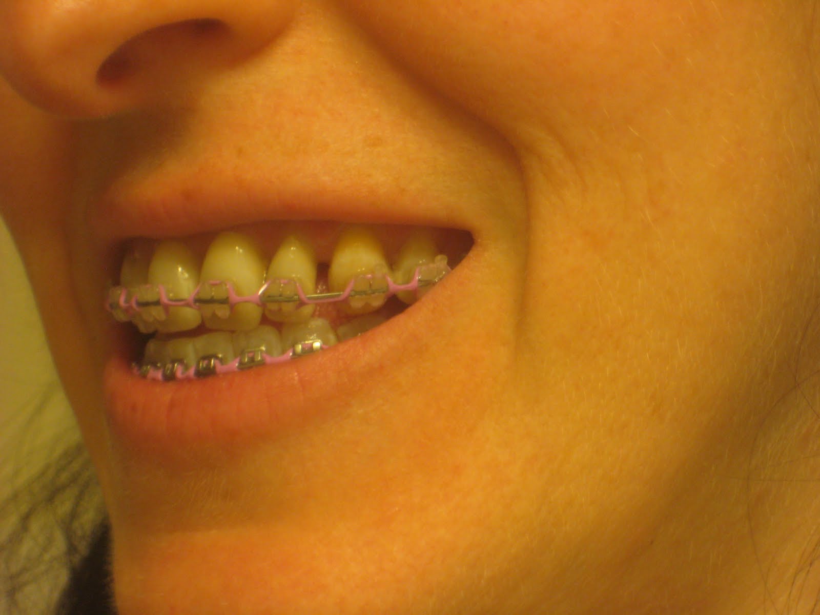 SARPE, Jaw Surgery and Adult Braces, Oh My! Second surgery update