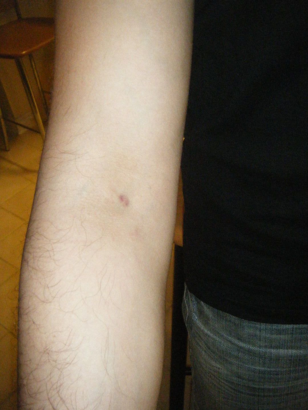 Why Does My Arm Hurt When I Donate Plasma