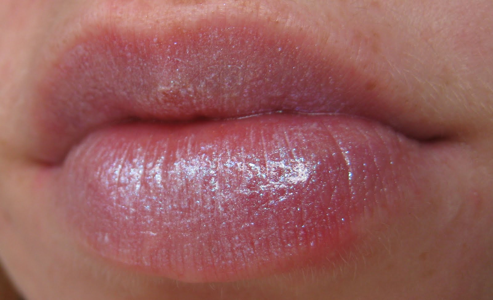 herpes lips #10