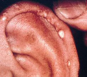 Tophi gout in hand: MedlinePlus Medical Encyclopedia Image