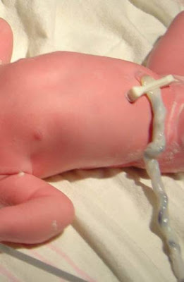 newborn umbilical cord