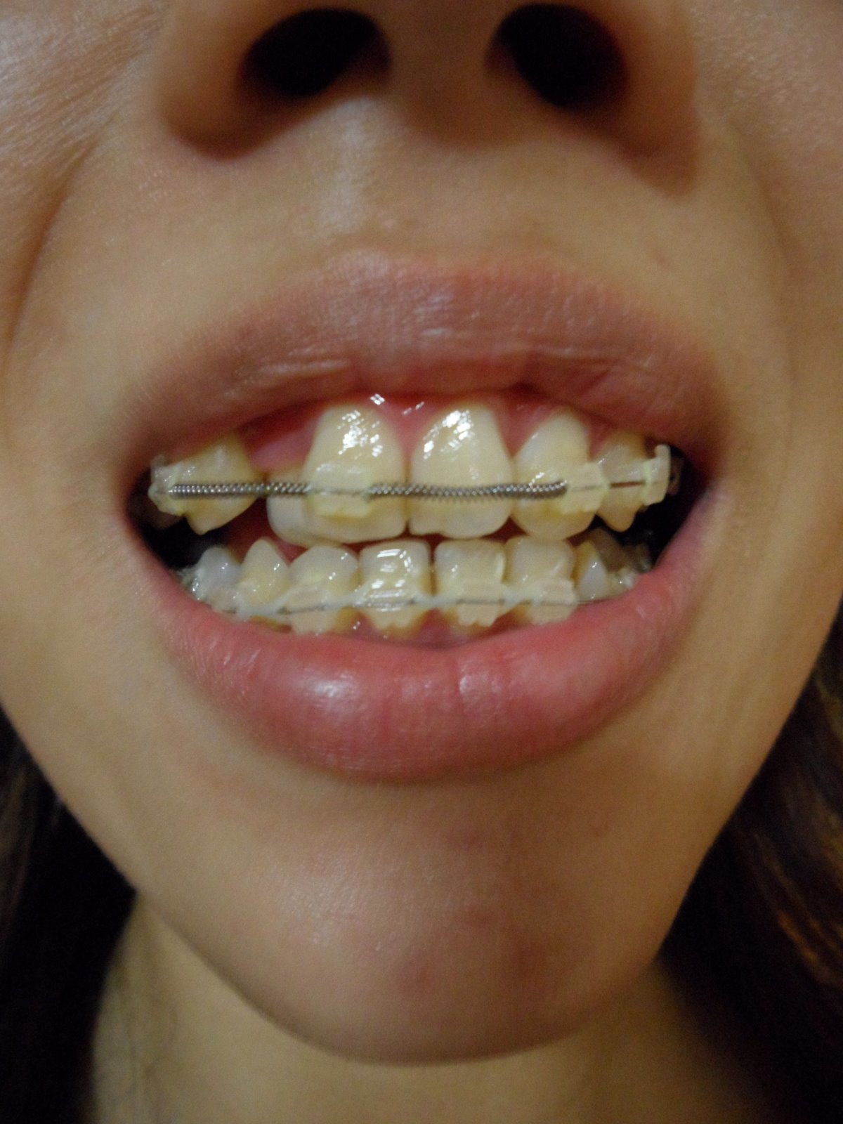 PamCake's Ceramic Braces Journey Images to 3rd Adjustment Springs