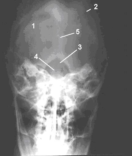 Towne View Radiology : AP Axial Towne and PA Axial Haas Methods in ...