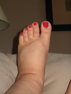 swollen feet due to hellp