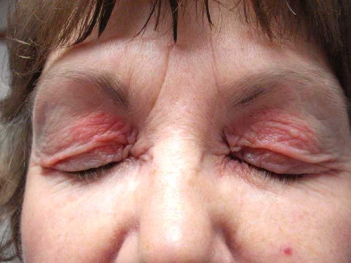 Eye Allergy Symptoms, Treatment, Causes - What are eyelid ...