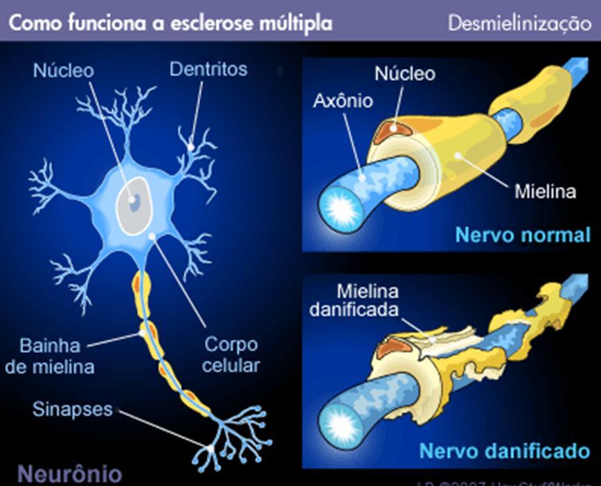 Patologia de Órgãos e Sistemas: ESCLEROSE MULTIPLAS