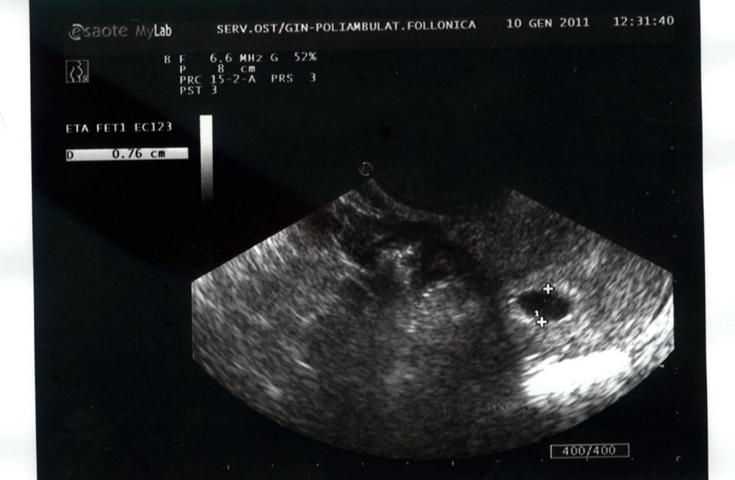 Foto Feto 12 Settimana Di Gravidanza