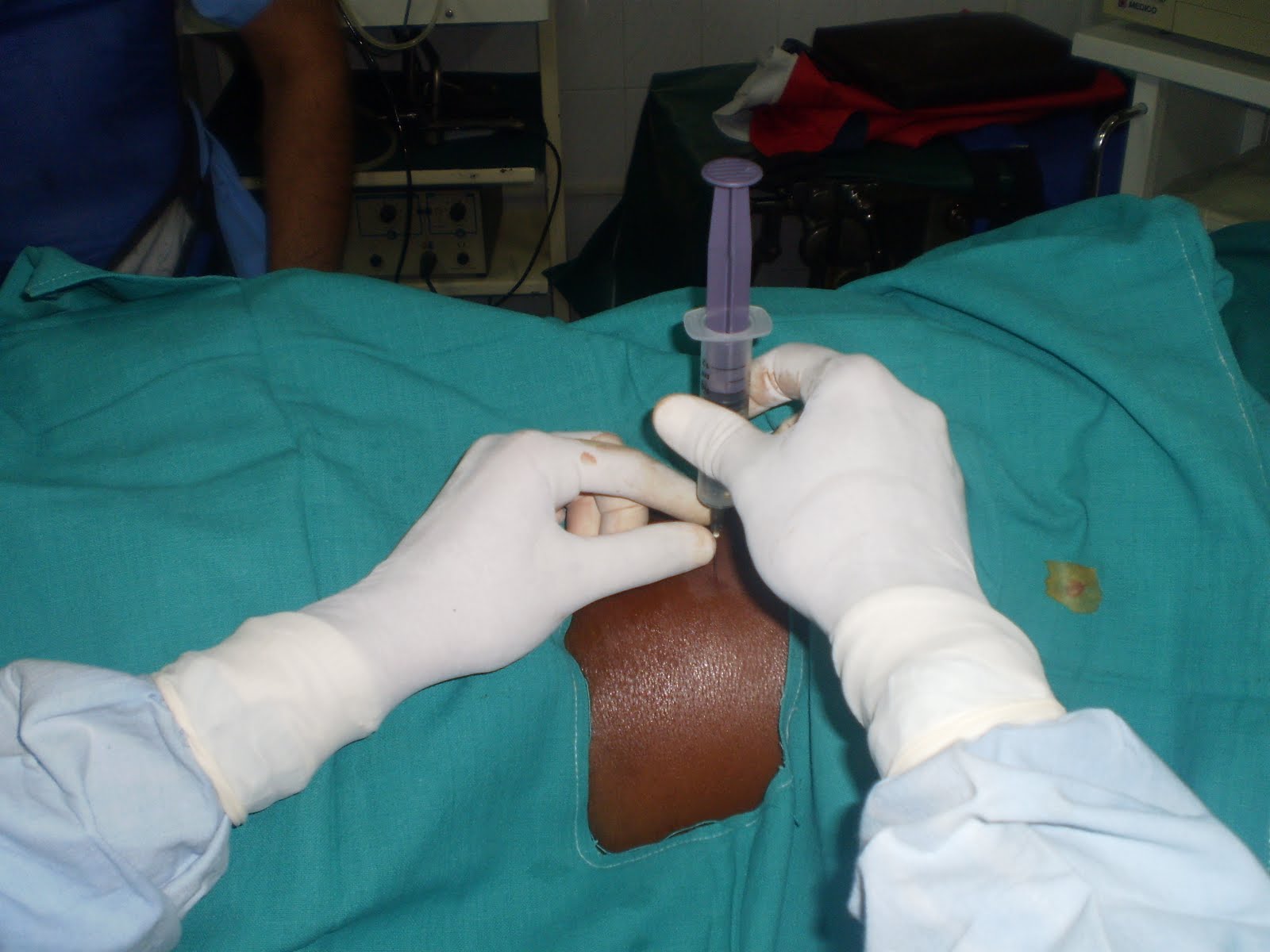 Ramayya Pramila Urology Hospital Percutaneous Nephrostomy