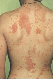 [sedef+hastalığı-2.jpg]