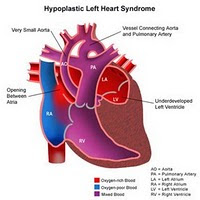 Hypoplastic Left Heart
