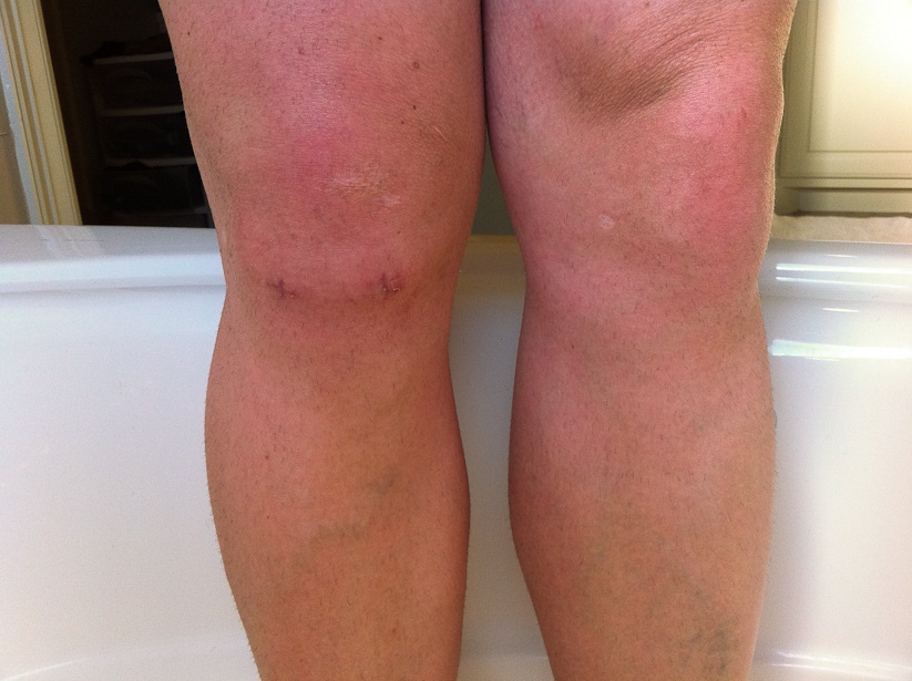 Knee Injuries Knee Injuries Lump Below The Kneecap